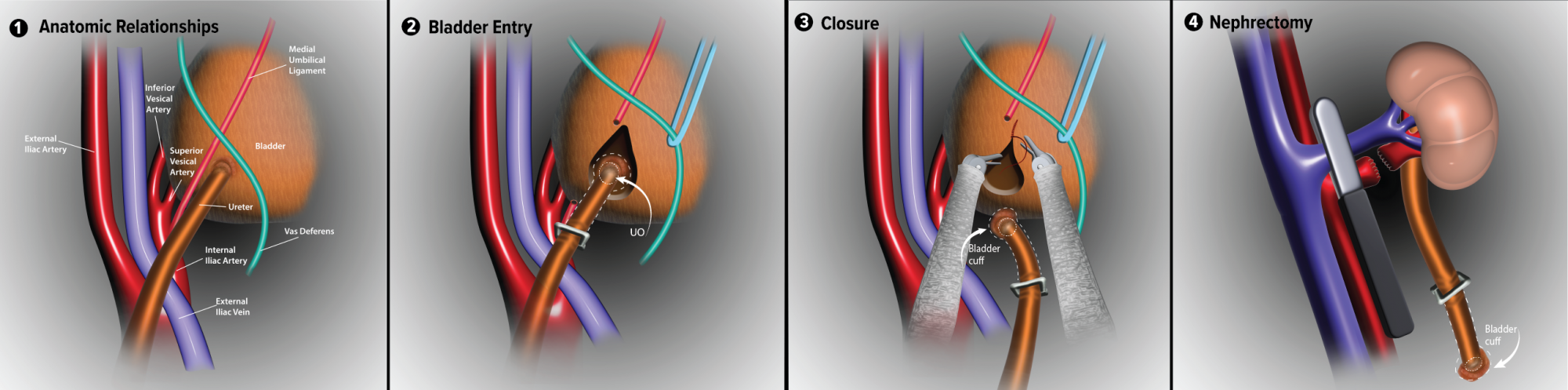 colorful science images of bladder surgery