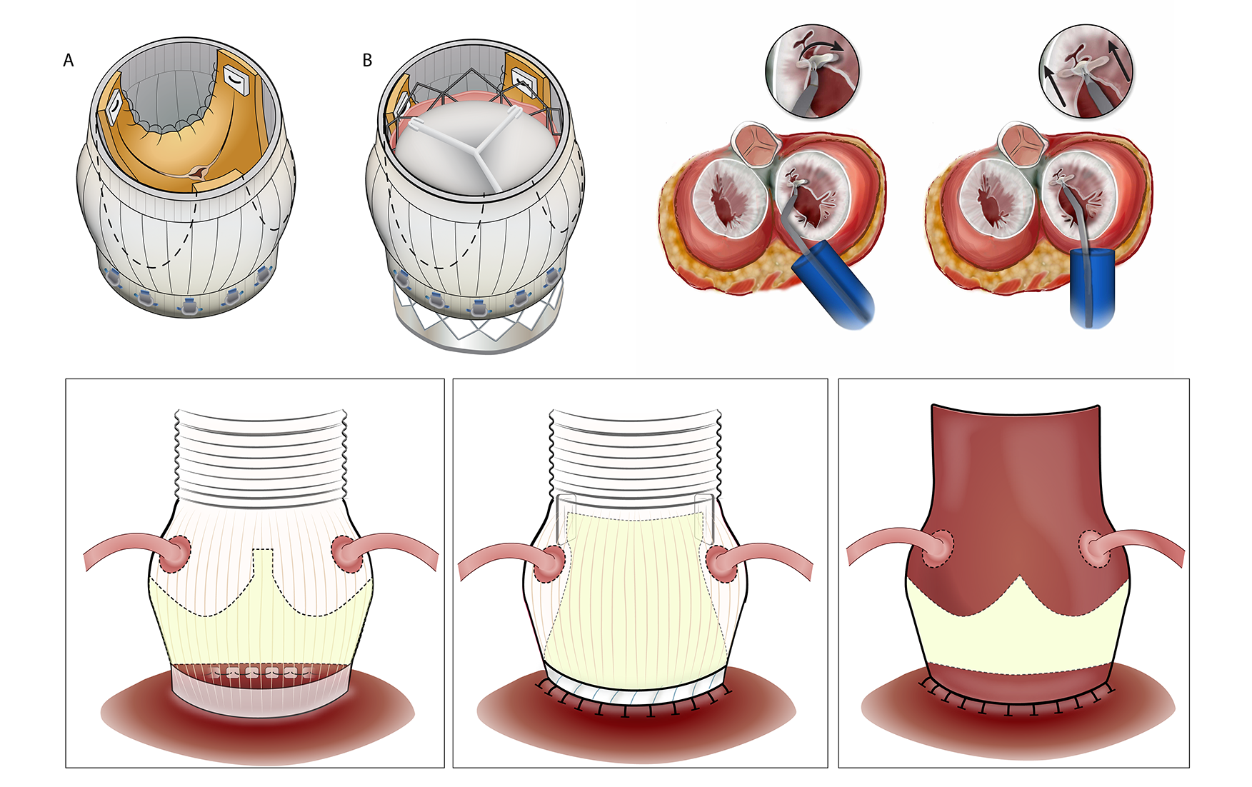 Cardiology heart valves