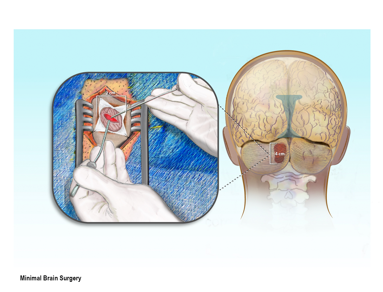 Brain surgery head and brain