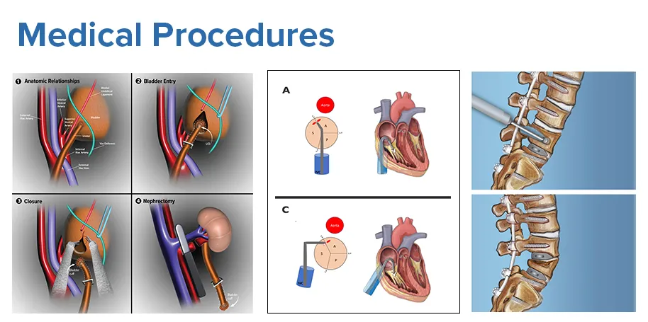 Composite of medical illustrations showing a step-by-step urologic procedure, heart catheter positioning labeled “challenging” and “ideal,” and spinal fixation with hardware along the vertebrae.