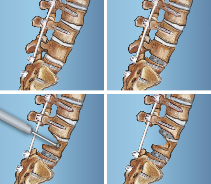 Spinal surgery